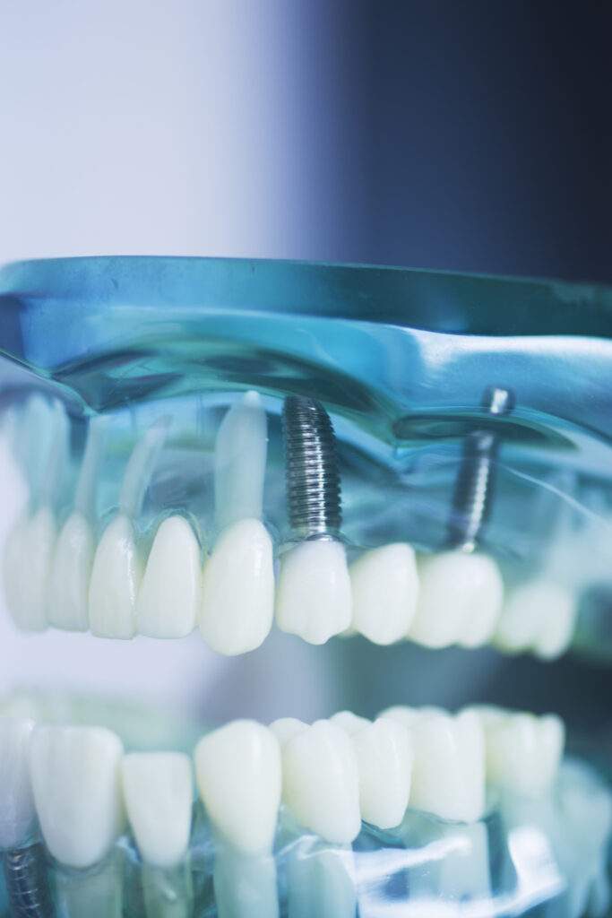 Implantes dentales en Torrijos